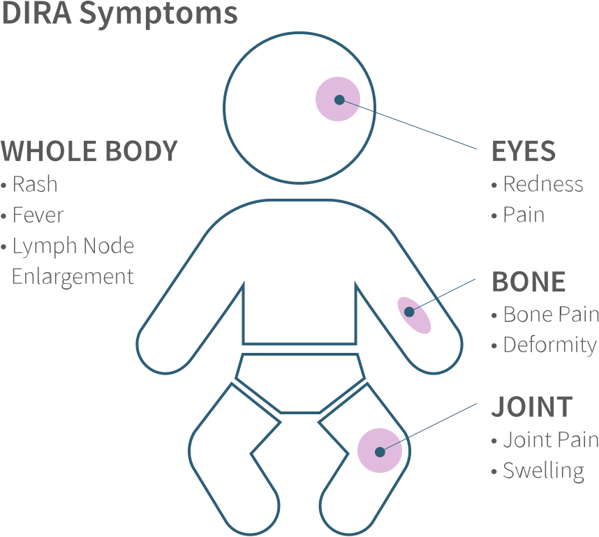 An illustrated outline of a baby with arrows that point to areas of the body where DIRA symptoms may manifest including EYES, BONES, JOINTS, and WHOLE BODY